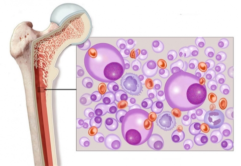 Phương pháp xét nghiệm mới giúp phát hiện sớm nguy cơ mắc đa u tủy xương