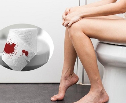 Biến chứng nào xảy ra nếu bệnh trĩ không được điều trị kịp thời