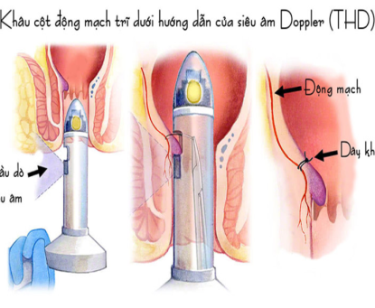 Điều trị bệnh trĩ bằng phương pháp khâu triệt mạch dưới hướng dẫn Doppler