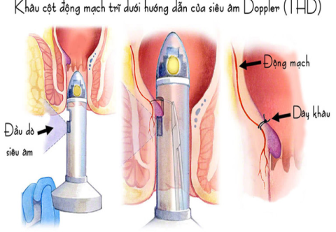 Điều trị bệnh trĩ bằng phương pháp khâu triệt mạch dưới hướng dẫn Doppler