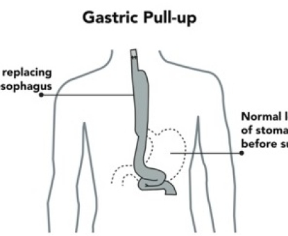 Sau cắt thực quản, có phương tiện nào thay thế không? Làm cách nào để bệnh nhân ăn uống được