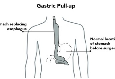 Sau cắt thực quản, có phương tiện nào thay thế không? Làm cách nào để bệnh nhân ăn uống được