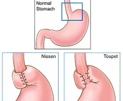 Phẫu thuật tạo van chống trào ngược