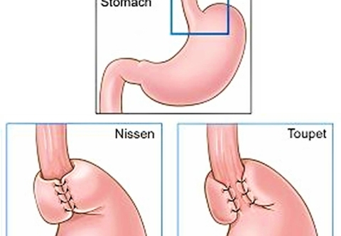 Phẫu thuật tạo van chống trào ngược