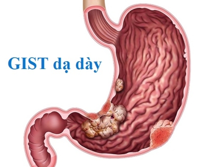 GIST dạ dày
