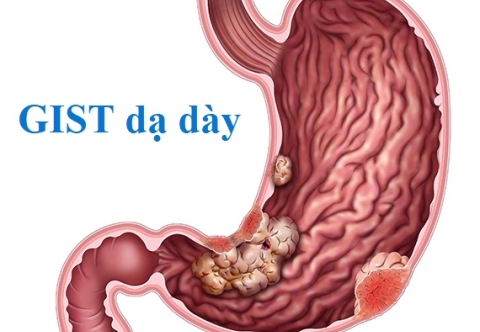 GIST dạ dày