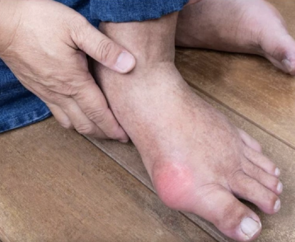 Béo phì và nguy Cơ Bệnh Gút