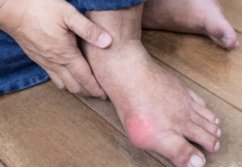 Béo phì và nguy Cơ Bệnh Gút