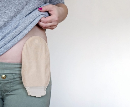 Hướng dẫn chăm sóc hậu môn nhân tạo sau mổ cắt đại tràng, trực tràng