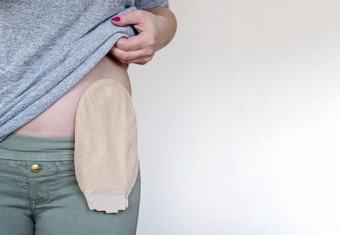 Hướng dẫn chăm sóc hậu môn nhân tạo sau mổ cắt đại tràng, trực tràng