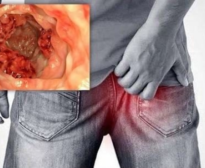 Các loại giải phẫu bệnh của ung thư ống hậu môn