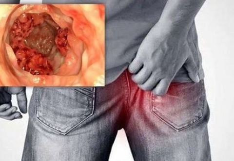 Các loại giải phẫu bệnh của ung thư ống hậu môn