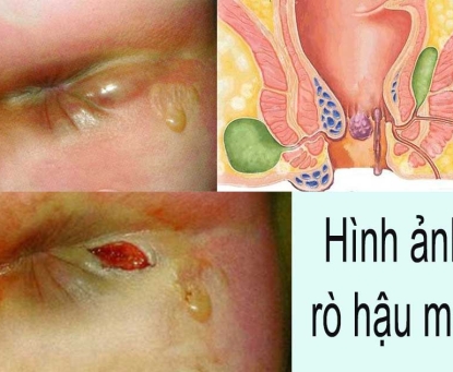 Triệu chứng nhận biết sớm bệnh rò hậu môn