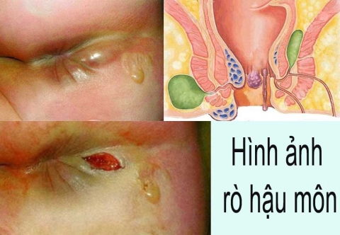 Triệu chứng nhận biết sớm bệnh rò hậu môn