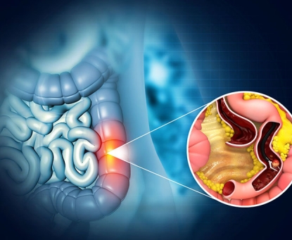 Nguyên nhân mắc ung thư đại tràng