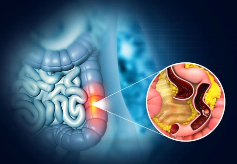 Nguyên nhân mắc ung thư đại tràng