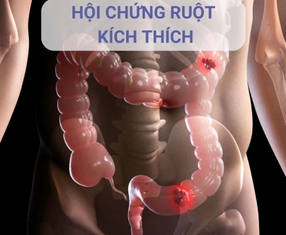 IBS có gây ra máu trong phân hoặc sốt không?