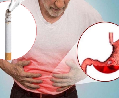 Nghiện thuốc lá và mối liên quan với trào ngược dạ dày thực quản