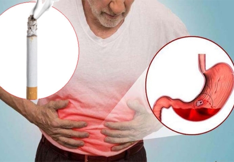 Nghiện thuốc lá và mối liên quan với trào ngược dạ dày thực quản