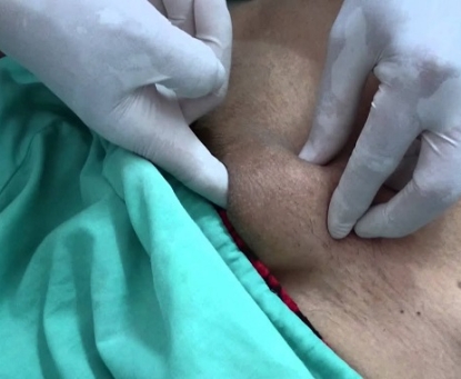 Khi nào khối phồng ở vùng bẹn có thể trở nên nguy hiểm?