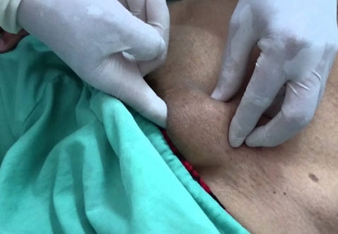 Khi nào khối phồng ở vùng bẹn có thể trở nên nguy hiểm?