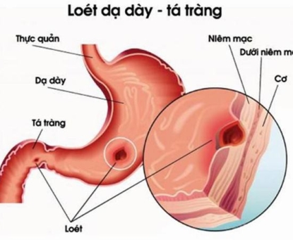 Dấu hiệu và cách điều trị bệnh thủng ổ loét dạ dày, tá tràng 