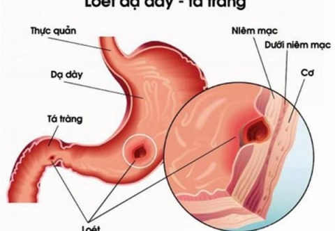 Dấu hiệu và cách điều trị bệnh thủng ổ loét dạ dày, tá tràng 