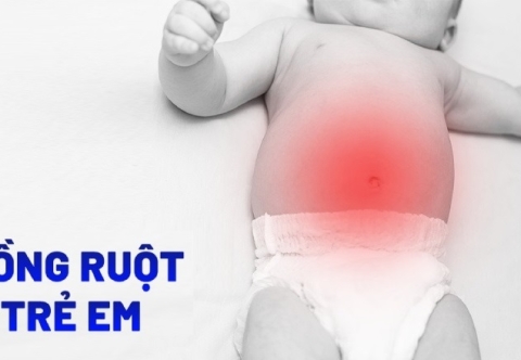 Lồng ruột ở trẻ em: Nguyên nhân, dấu hiệu và cách điều trị