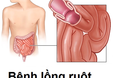 Chẩn đoán lồng ruột: Các phương pháp hiện đại và độ chính xác