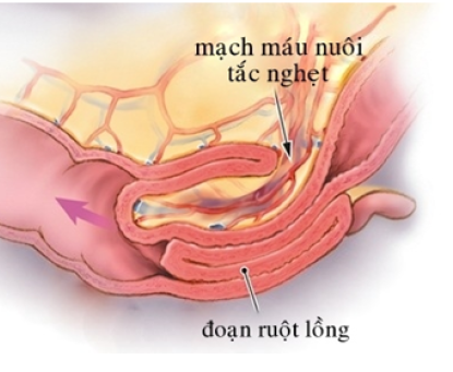 Lồng ruột - Nguyên nhân, triệu chứng và cách nhận biết sớm