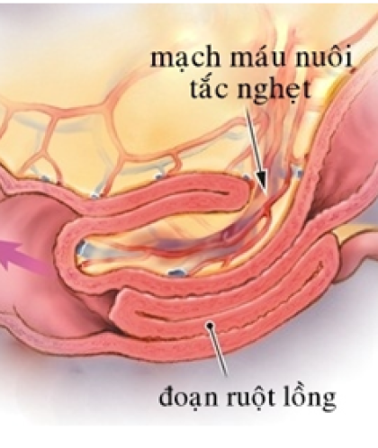 Phát hiện sớm bệnh lồng ruột