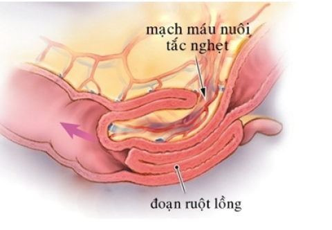 Lồng ruột - Nguyên nhân, triệu chứng và cách nhận biết sớm