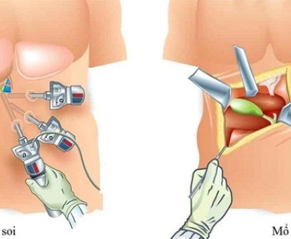 Hướng dẫn bệnh nhân sau mổ sỏi mật