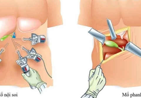 Hướng dẫn bệnh nhân sau mổ sỏi mật