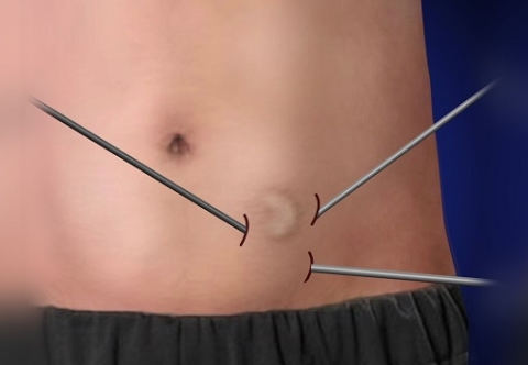 Phẫu thuật nội soi thoát vị bẹn