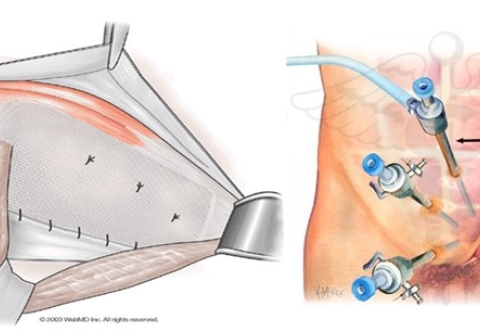 Phẫu thuật điều trị thoát vị bẹn