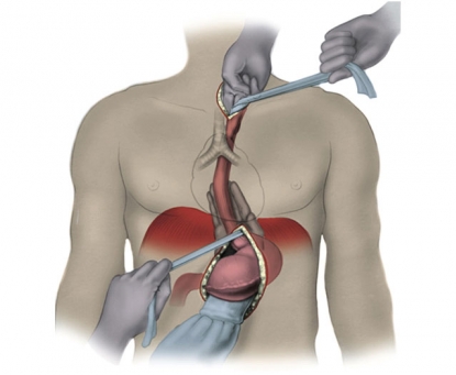 Hướng dẫn chăm sóc sau mổ cắt thực quản triệt căn điều trị ung thư thực quản