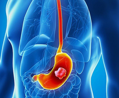 Béo phì làm tăng nguy cơ mắc bệnh ung thư như thế nào