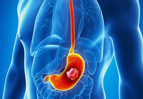 Béo phì làm tăng nguy cơ mắc bệnh ung thư như thế nào