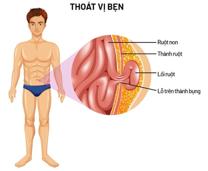 Cẩm nang phòng ngừa bệnh thoát vị bẹn