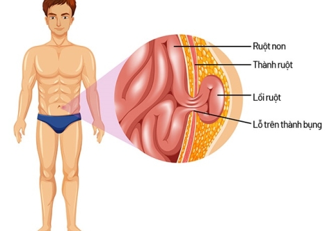 Cẩm nang phòng ngừa bệnh thoát vị bẹn