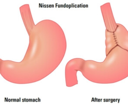 Hướng dẫn chăm sóc sau mổ tạo van chống trào ngược Nissen
