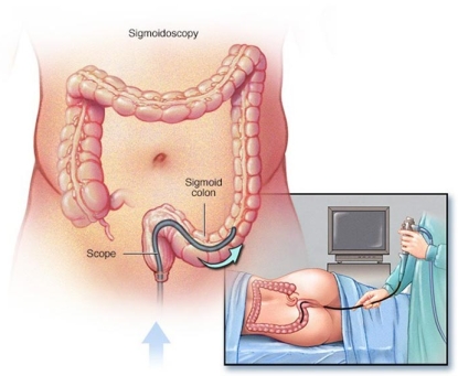 Polyp đại tràng có thể phát hiện qua những phương pháp nào?