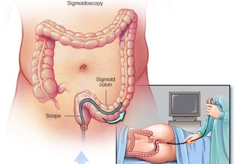 Polyp đại tràng có thể phát hiện qua những phương pháp nào?