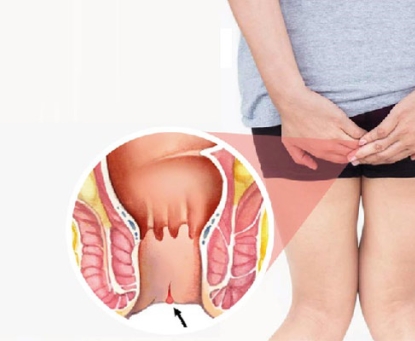 Tổng quan về dự phòng bệnh nứt kẽ hậu môn