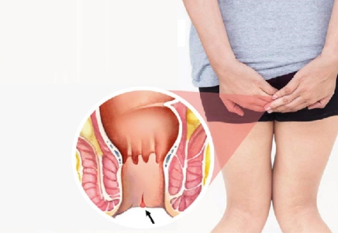 Tổng quan về dự phòng bệnh nứt kẽ hậu môn