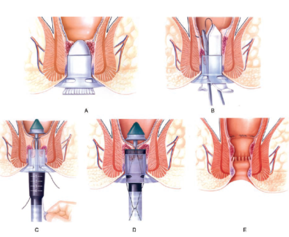 Hướng dẫn chăm sóc sau phẫu thuật Longo điều trị trĩ