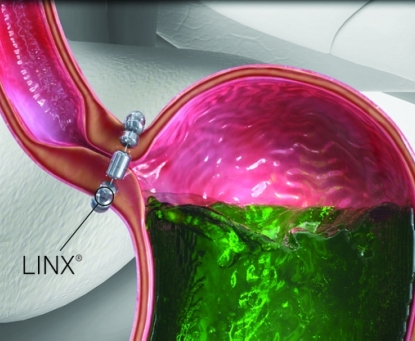 Phẫu thuật LINX, một phương pháp mới, can thiệp tối thiểu điều trị trào ngược dạ dày thực quản
