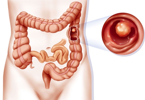 Phòng ngừa biến chứng Polyp trực tràng gây ung thư trực tràng