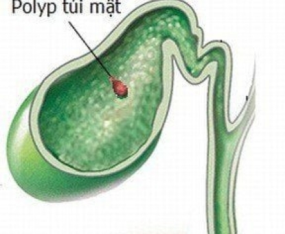 Polyp túi mật là gì